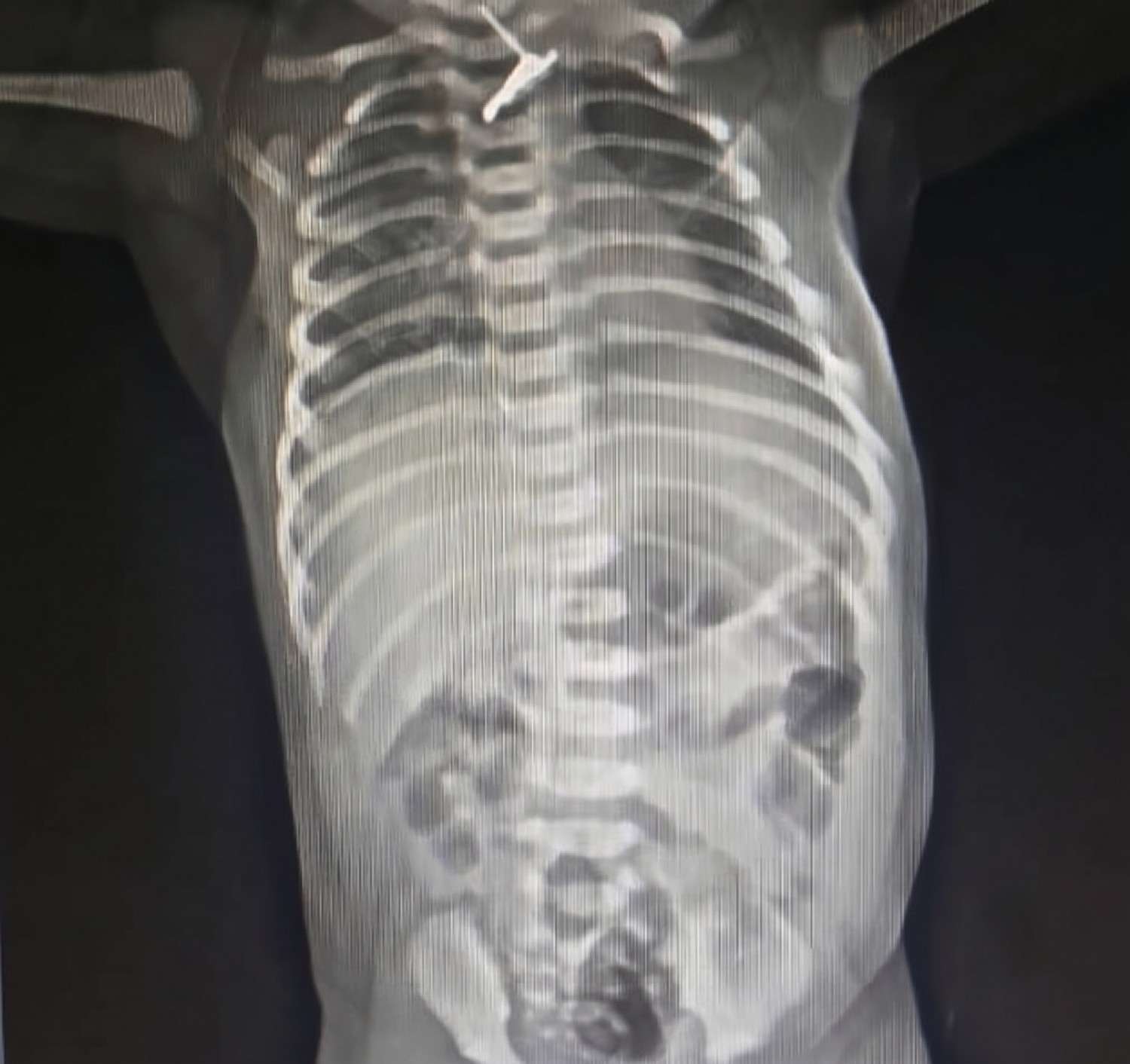 Radiographic evaluation demonstrating the foreign body in the upper aerodigestive region